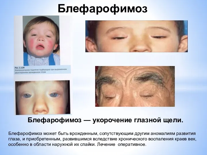 Блефарофимоз может быть врожденным, сопутствующим другим аномалиям развития глаза, и приобретенным,