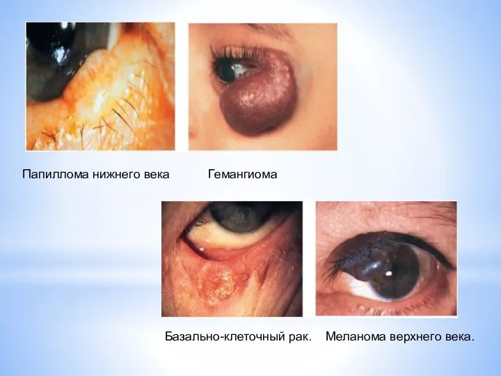 Папиллома нижнего века Гемангиома Базально-клеточный рак. Меланома верхнего века.