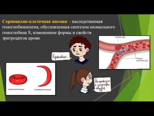 Серповидно-клеточная анемия – наследственная гемоглобинопатия, обусловленная синтезом аномального гемоглобина S, изменением формы и свойств эритроцитов крови.