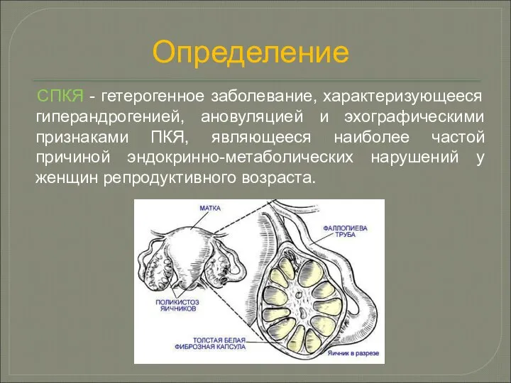 Определение СПКЯ - гетерогенное заболевание, характеризующееся гиперандрогенией, ановуляцией и эхографическими признаками