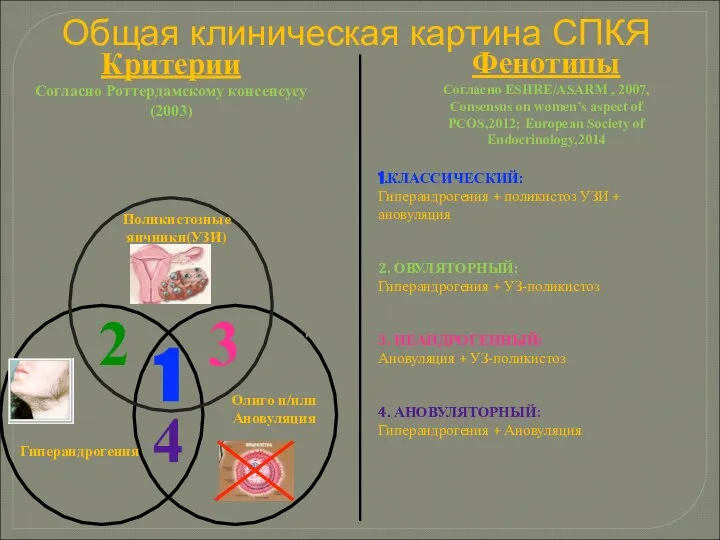 1.КЛАССИЧЕСКИЙ: Гиперандрогения + поликистоз УЗИ + ановуляция 2. ОВУЛЯТОРНЫЙ: Гиперандрогения +