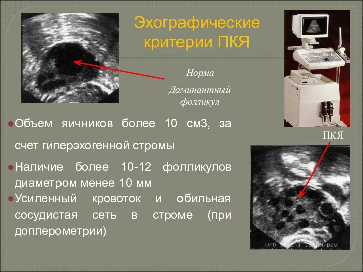 Объем яичников более 10 см3, за счет гиперэхогенной стромы Наличие более