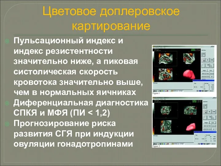 Цветовое доплеровское картирование Пульсационный индекс и индекс резистентности значительно ниже, а