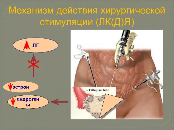 Механизм действия хирургической стимуляции (ЛК(Д)Я) андрогены эстрон ЛГ