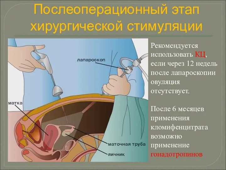 Рекомендуется использовать КЦ, если через 12 недель после лапароскопии овуляция отсутствует.