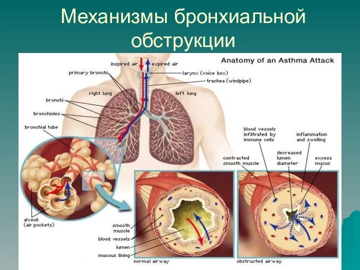 Механизмы бронхиальной обструкции