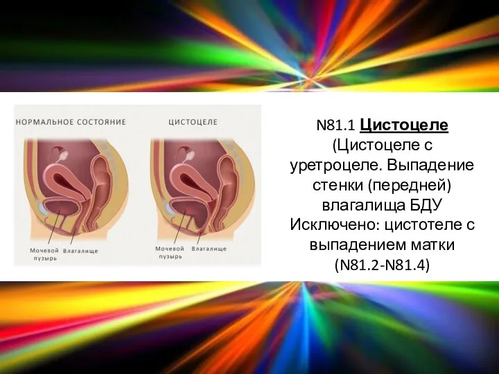 N81.1 Цистоцеле (Цистоцеле с уретроцеле. Выпадение стенки (передней) влагалища БДУ Исключено: цистотеле с выпадением матки (N81.2-N81.4)