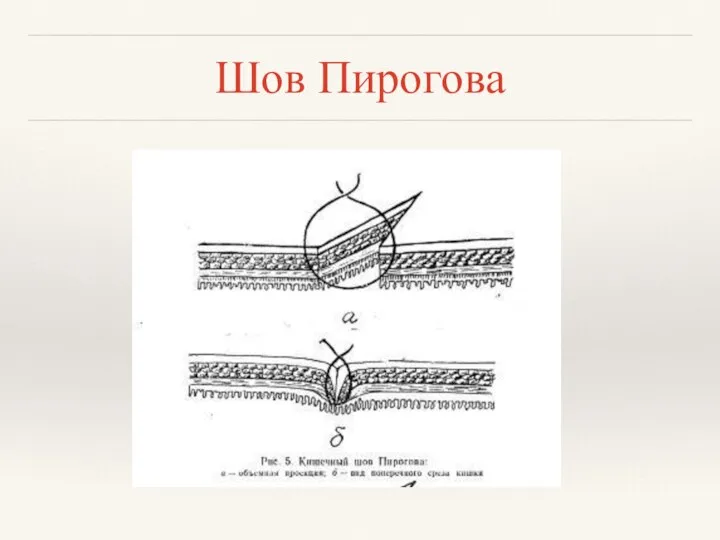 Шов Пирогова