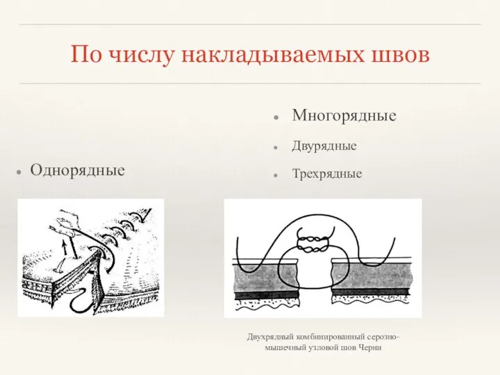 По числу накладываемых швов Однорядные Двухрядный комбинированный серозно-мышечный узловой шов Черни Многорядные Двурядные Трехрядные