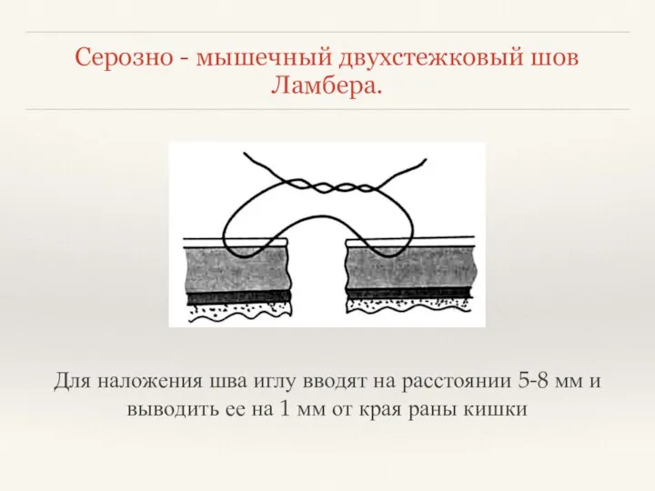 Серозно - мышечный двухстежковый шов Ламбера. Для наложения шва иглу вводят