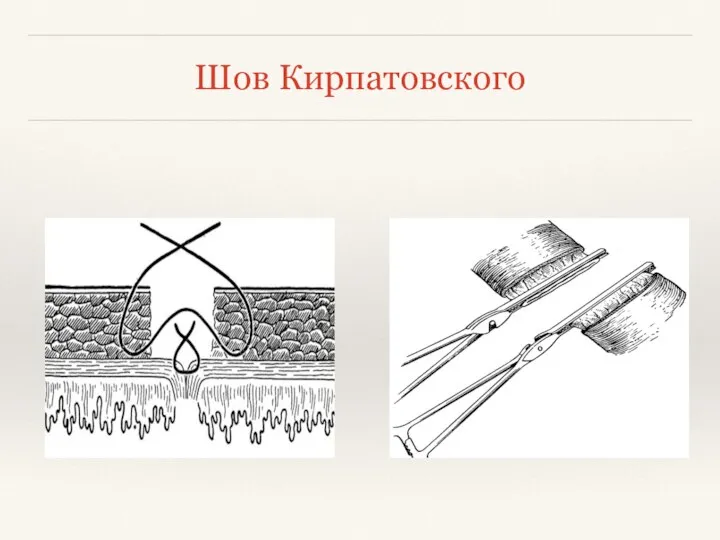 Шов Кирпатовского