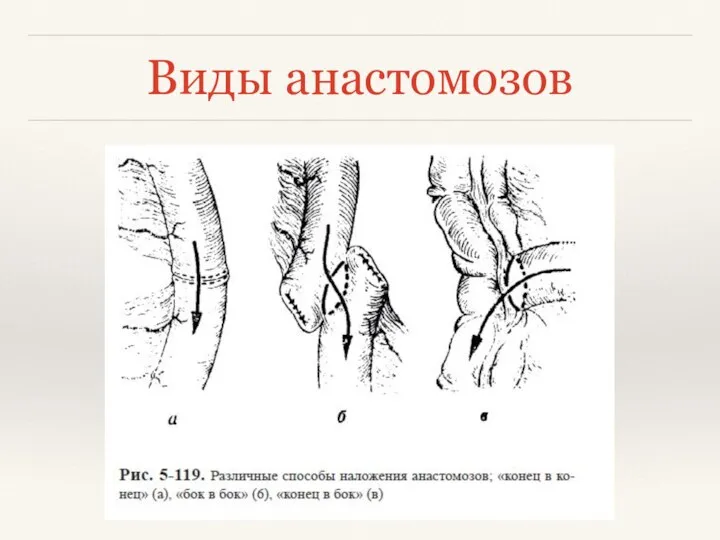 Виды анастомозов