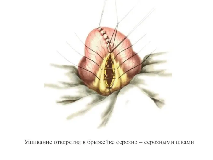 Ушивание отверстия в брыжейке серозно – серозными швами