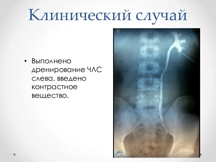 Клинический случай Выполнено дренирование ЧЛС слева, введено контрастное вещество.