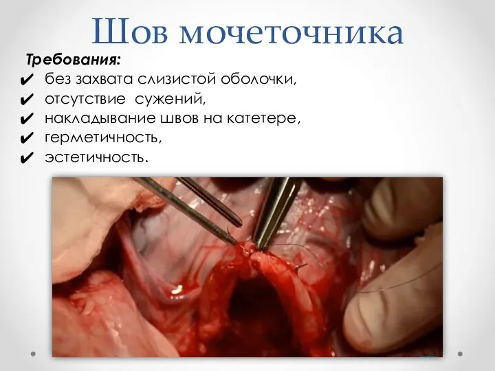 Шов мочеточника Требования: без захвата слизистой оболочки, отсутствие сужений, накладывание швов на катетере, герметичность, эстетичность.