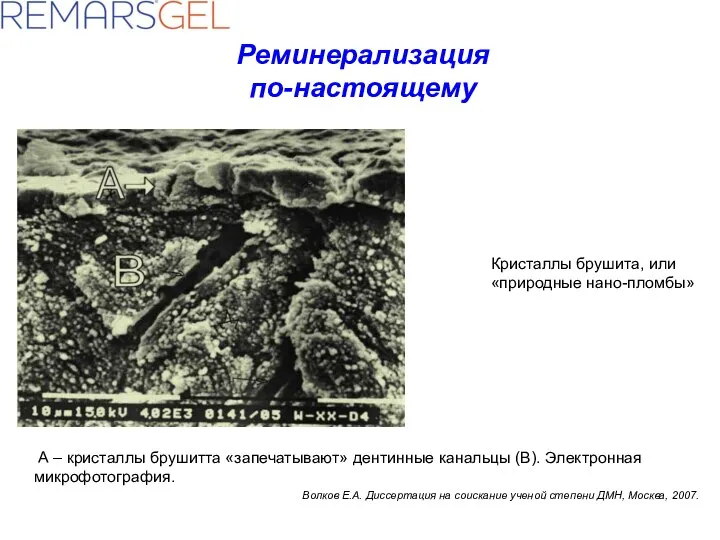 Кристаллы брушита, или «природные нано-пломбы» А – кристаллы брушитта «запечатывают» дентинные