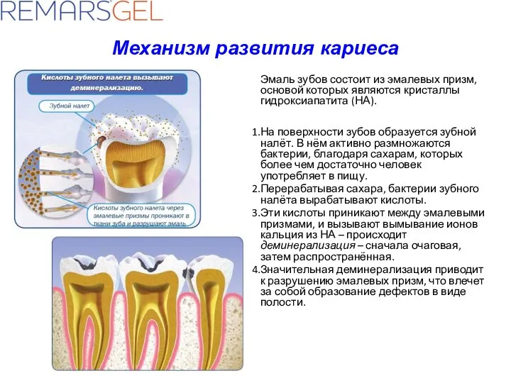 Механизм развития кариеса Эмаль зубов состоит из эмалевых призм, основой которых