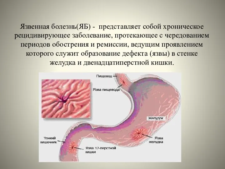 Язвенная болезнь(ЯБ) - представляет собой хроническое рецидивирующее заболевание, протекающее с чередованием