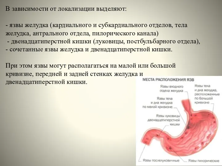 В зависимости от локализации выделяют: - язвы желудка (кардиального и субкардиального