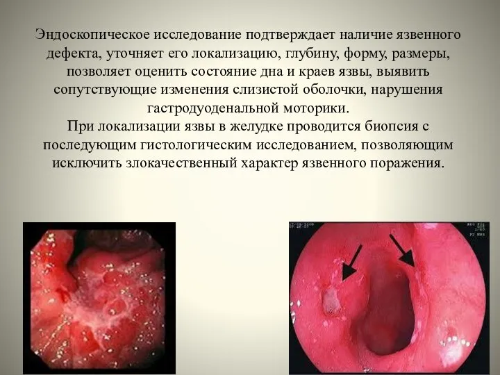 Эндоскопическое исследование подтверждает наличие язвенного дефекта, уточняет его локализацию, глубину, форму,