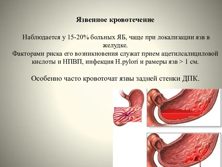 Язвенное кровотечение Наблюдается у 15-20% больных ЯБ, чаще при локализации язв