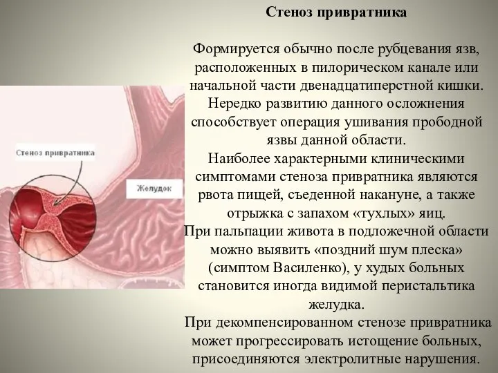 Стеноз привратника Формируется обычно после рубцевания язв, расположенных в пилорическом канале