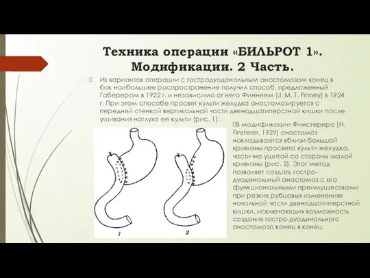 Из вариантов операции с гастродуоденальным анастомозом конец в бок наибольшее распространение