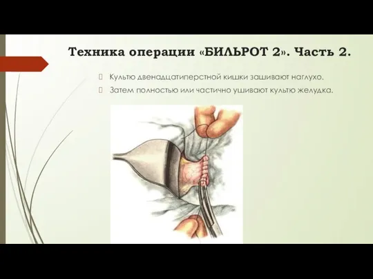 Культю двенадцатиперстной кишки зашивают наглухо. Затем полностью или частично ушивают культю