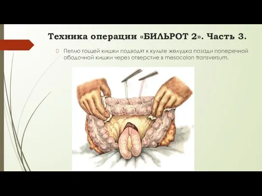 Петлю тощей кишки подводят к культе желудка позади поперечной ободочной кишки