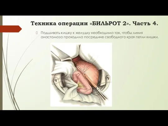 Подшивать кишку к желудку необходимо так, чтобы линия анастомоза проходила посредине