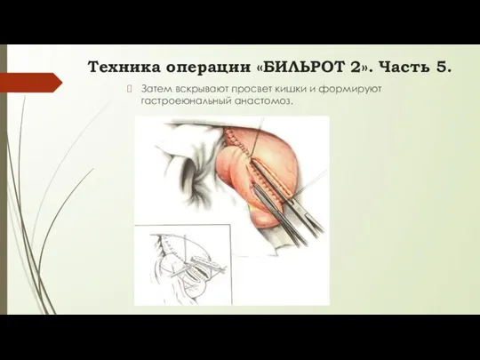 Затем вскрывают просвет кишки и формируют гастроеюнальный анастомоз. Техника операции «БИЛЬРОТ 2». Часть 5.