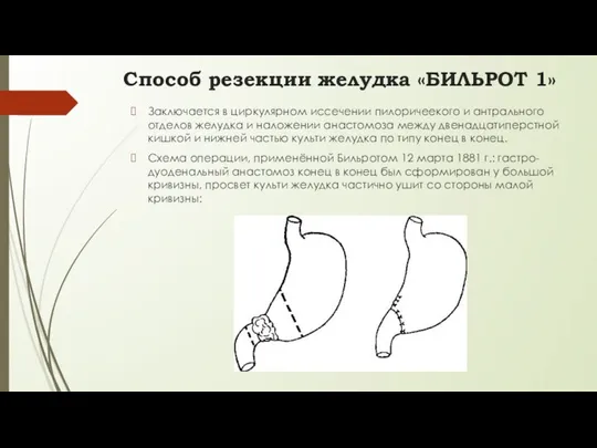 Способ резекции желудка «БИЛЬРОТ 1» Заключается в циркулярном иссечении пилоричеекого и