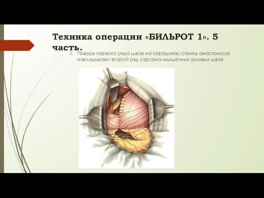 Поверх первого ряда швов на переднюю стенку анастомоза накладывают второй ряд