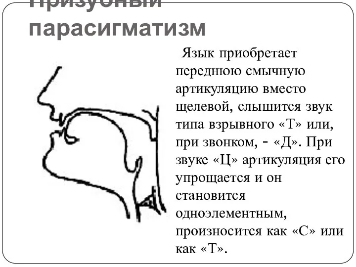 Призубный парасигматизм Язык приобретает переднюю смычную артикуляцию вместо щелевой, слышится звук