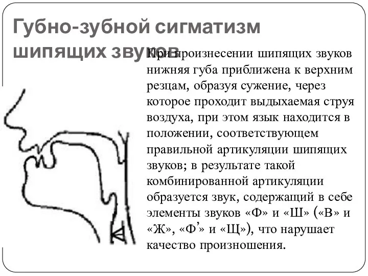 Губно-зубной сигматизм шипящих звуков При произнесении шипящих звуков нижняя губа приближена