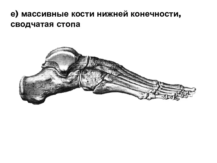 е) массивные кости нижней конечности, сводчатая стопа