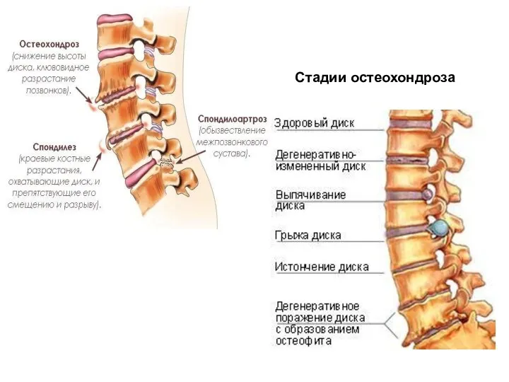 Ст Стадии остеохондроза