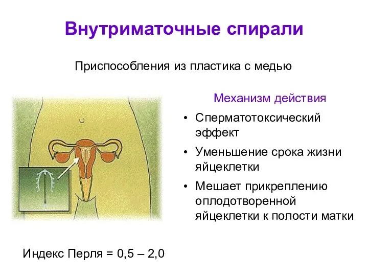 Внутриматочные спирали Механизм действия Сперматотоксический эффект Уменьшение срока жизни яйцеклетки Мешает