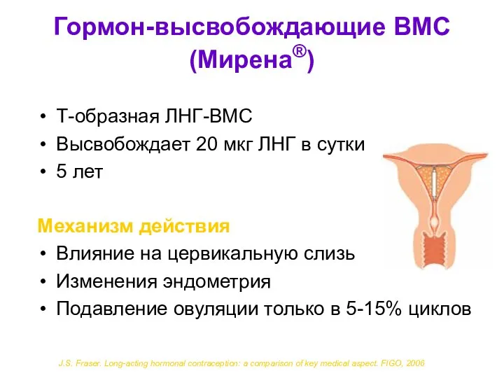 Гормон-высвобождающие ВМС (Мирена®) Т-образная ЛНГ-ВМС Высвобождает 20 мкг ЛНГ в сутки