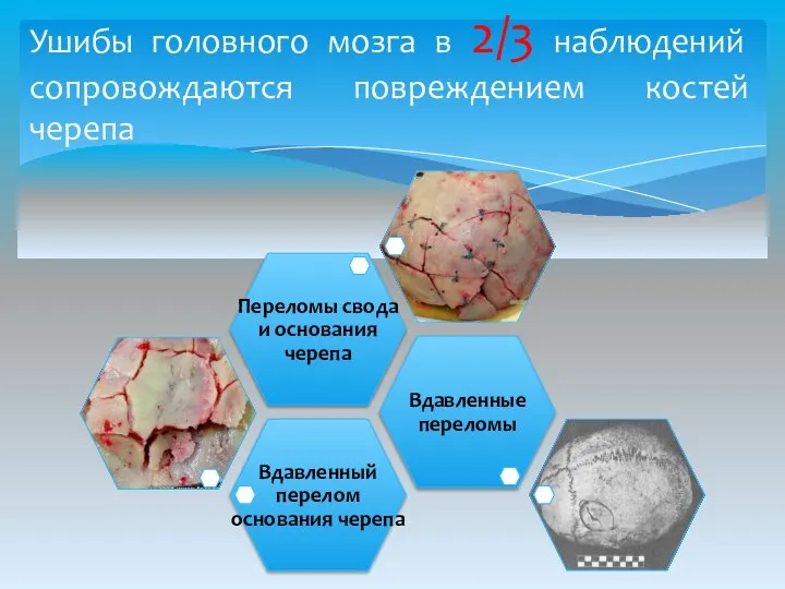 Ушибы головного мозга в 2/3 наблюдений сопровождаются повреждением костей черепа