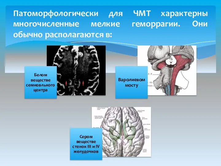 Патоморфологически для ЧМТ характерны многочисленные мелкие геморрагии. Они обычно располагаются в: