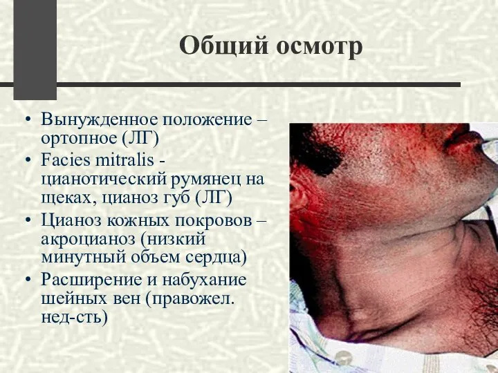 Общий осмотр Вынужденное положение – ортопное (ЛГ) Facies mitralis - цианотический