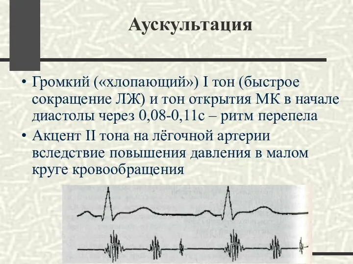 Аускультация Громкий («хлопающий») I тон (быстрое сокращение ЛЖ) и тон открытия