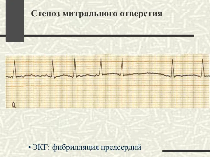 Стеноз митрального отверстия ЭКГ: фибрилляция предсердий