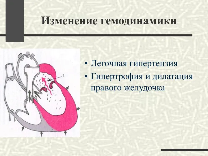 Изменение гемодинамики Легочная гипертензия Гипертрофия и дилатация правого желудочка