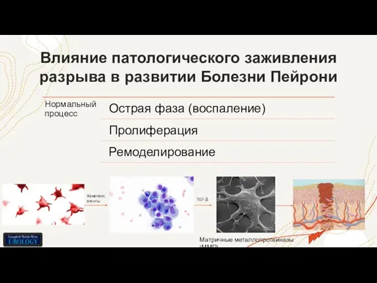 Влияние патологического заживления разрыва в развитии Болезни Пейрони Хемотакс. агенты TGF-β Матричные металлопротеиназы (ММП)