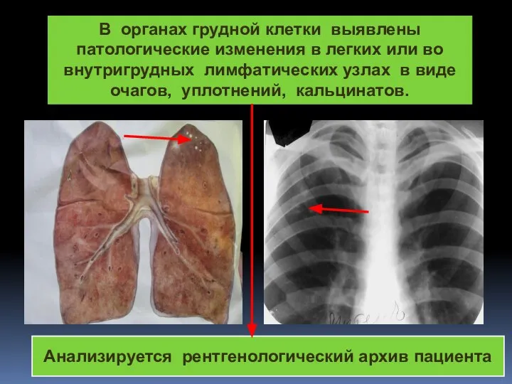 В органах грудной клетки выявлены патологические изменения в легких или во