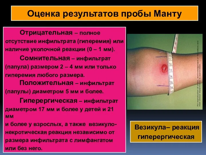 Оценка результатов пробы Манту Отрицательная – полное отсутствие инфильтрата (гиперемия) или