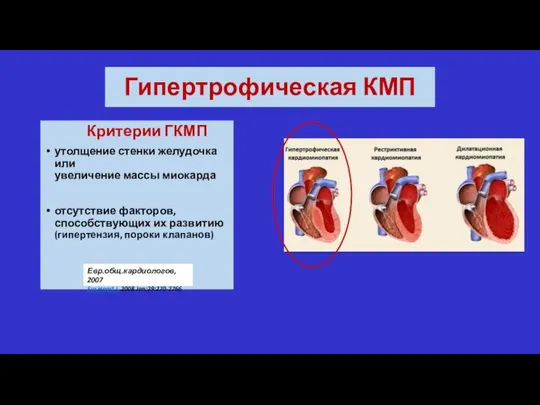 Гипертрофическая КМП Критерии ГКМП утолщение стенки желудочка или увеличение массы миокарда