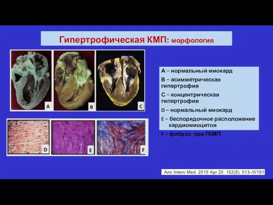 Гипертрофическая КМП: морфология А – нормальный миокард В – асимметрическая гипертрофия